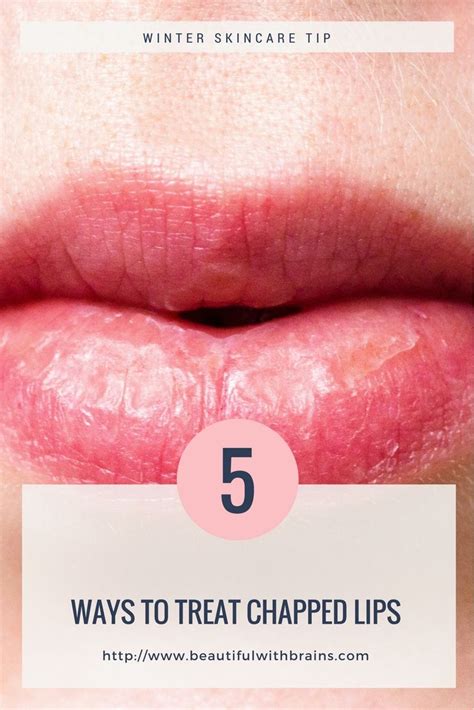 Chapped Lips Ways To Heal Them Quickly Beautiful With Brains