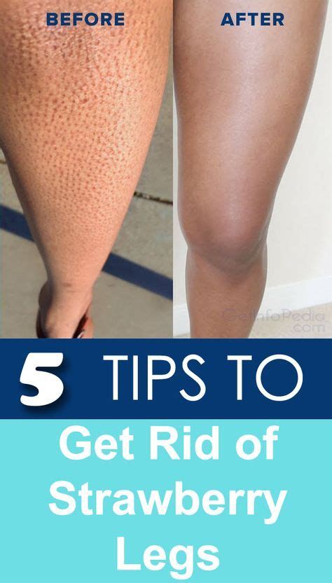 Strawberry Legs Ultimate Tips To Get Rid Of It Getinfopedia Diy