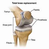 Pain Management After Knee Replacement Surgery