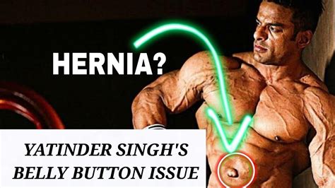 What Is Wrong With Yatinder Singhs Belly Button Is It Hernia Youtube
