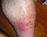 Lyme Disease Rash Itch Treatment Pictures