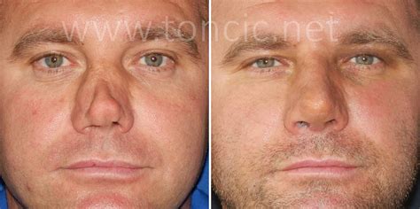 Rhinoplasty Cosmetic Nose Surgery Dr Toncic Clinic