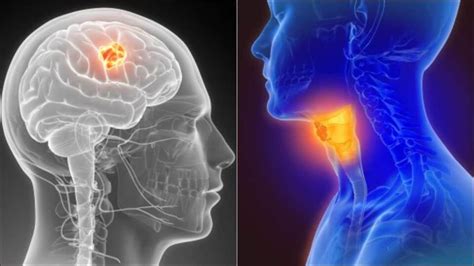 Cancer Cell Gene Deactivation Boosts Immunotherapy For Head Neck