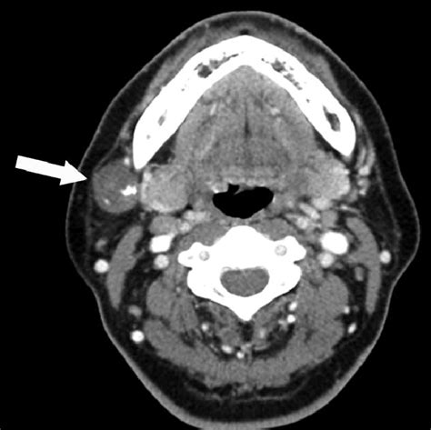 Neck Ct Scans Show A 21 Cm Sized Well Defined Poorly Enhancing Mass