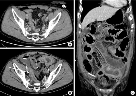 Figure 1 From Acute Ileal Perforation Caused By Radiation Enteritis After Restoration Semantic