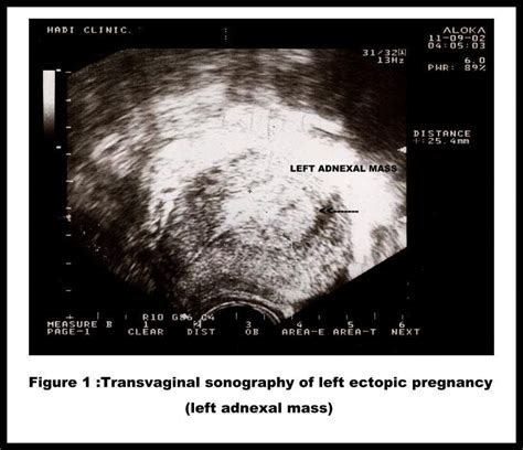 Tubal Ectopic Pregnancy Laparoscopy Vs Laparotomy