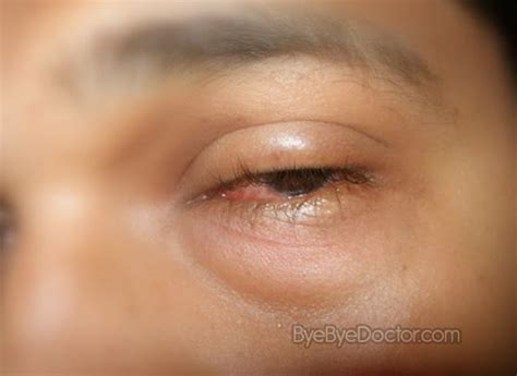 Eyelid Swelling Treatment Symptoms Causes Treatment And Prevention Of