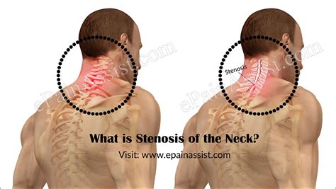 What Is Cervical Stenosis Understanding The Symptoms And Risks Becker
