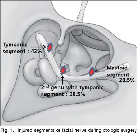 Table From How To Avoid Facial Nerve Injury In Mastoidectomy Semantic Scholar