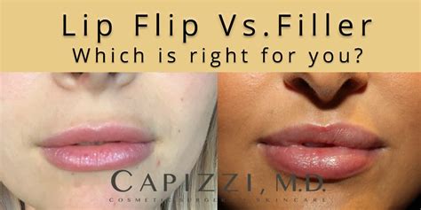 Lip Flip Botox Before And After Photos Infoupdate Wallpaper Images