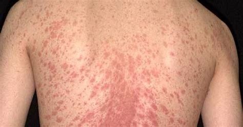 About Health Pityriasis Rosea