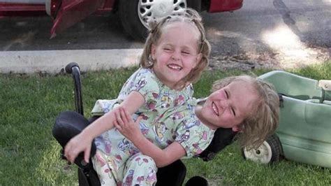 Conjoined Twins Separated In Risky Surgery 13 Years Ago Are Now