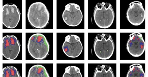 This Ai Tool Automatically Identifies Different Types Of Brain Injury