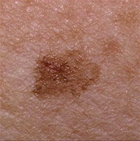 Multiple Lentigo Maligna Melanomas A Preliminary Report Dermatology