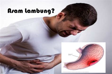 Pengertian Penyakit Asam Lambung Gejala Penyebab Diagnosis Dan Cara