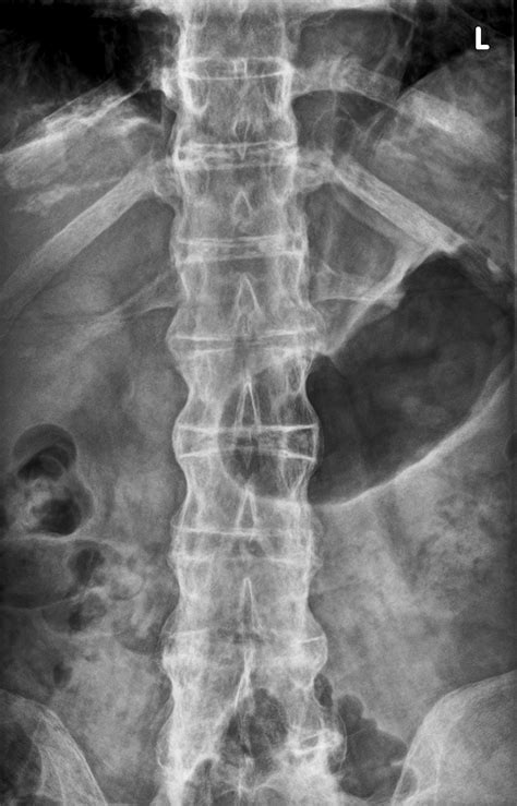 Bamboo Spine Of Ankylosing Spondylitis Image