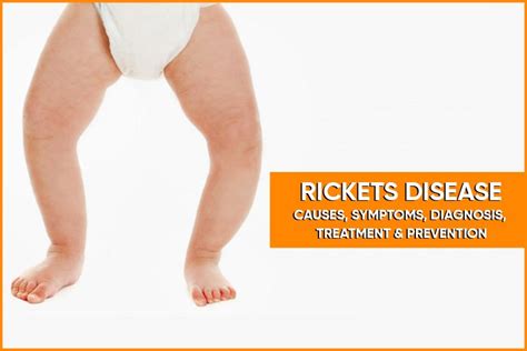 Rickets Disease Causes Symptoms Diagnosis Treatment And Prevention