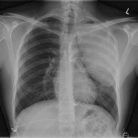 Chest X Ray Showed Consolidation Of The Upper Two Thirds Of The Left