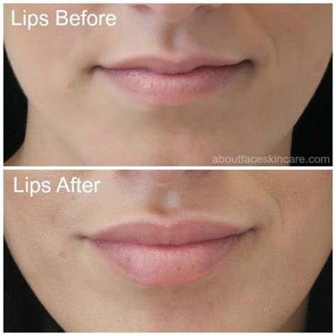 An Amazing Lip Injection Result Using Juvederm Lips Are Fuller