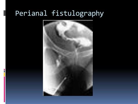 ppt mri imaging of perianal fistula powerpoint presentation id 2986971