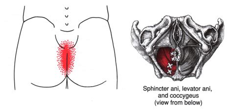 Pelvic Floor Trigger Point Injections The Floors