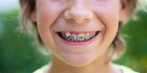 What Causes Crooked Teeth Ethos Orthodontics