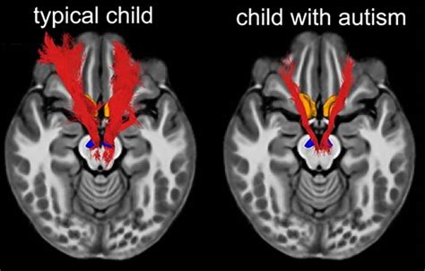 People With Autism Have Left And Right Brain Areas More Symmetrical