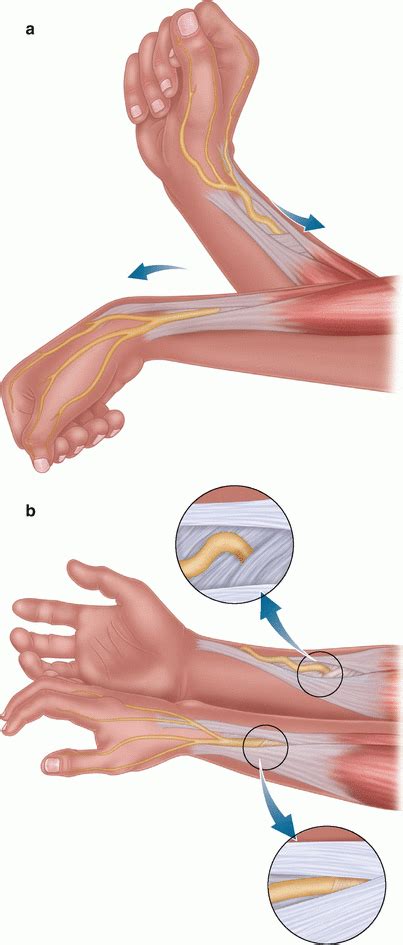 Compressive Neuropathies Of The Radial Nerve Musculoskeletal Key