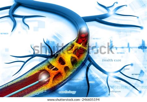 Stent Angioplasty Procedure Placing Balloon Stock Illustration 246605194