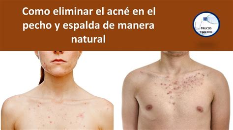 Como Eliminar El Acne En El Pecho Y Espalda De Manera Natural Youtube