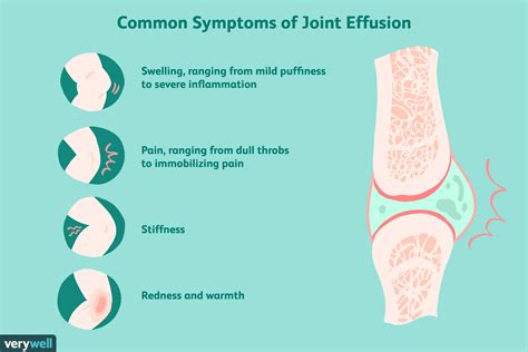 Joint Effusion What It Is Symptoms Treatment
