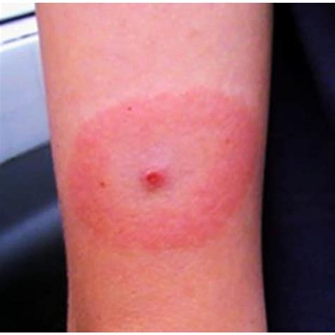 Erythema Migrans Em Like Lesion On Patient 3 Following Tick Exposure