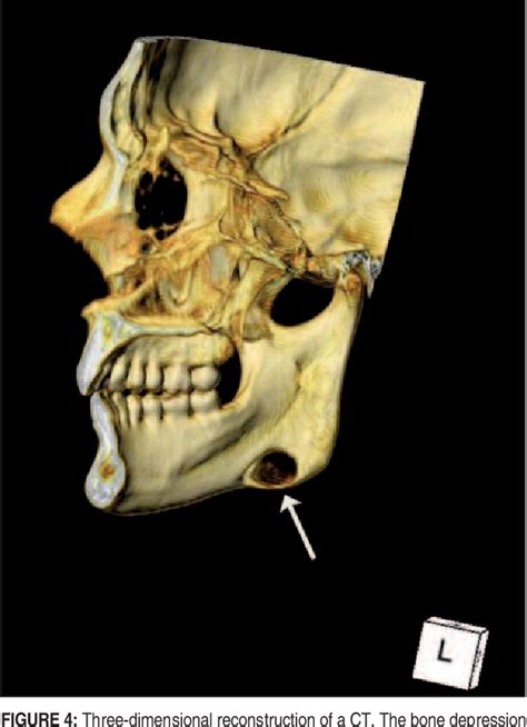 Figure 4 From Diagnosis And Evaluation Of Stafnes Bone Defect Using