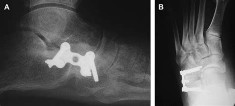 Tendon Transfers And Realignment Osteotomies For Treatment Of Stage Ii