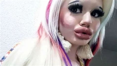 mujer obsesionada con tener los labios más grandes del mundo se somete a 15 cirugías e