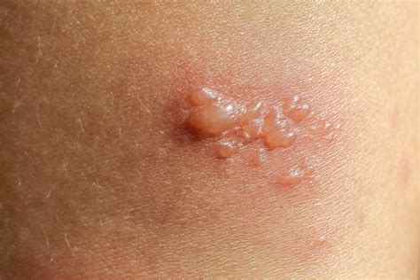 Skin Lesions Pictures Types Causes Treatment
