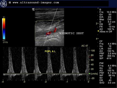 Doppler Study Severe Stenosis Of The Lower Limb Arteries
