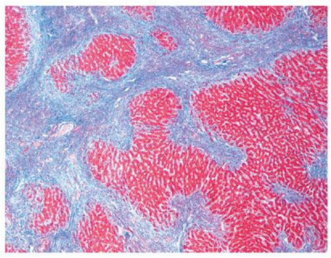 Basic Patterns Of Injury In Medical Liver Pathology Basicmedical Key