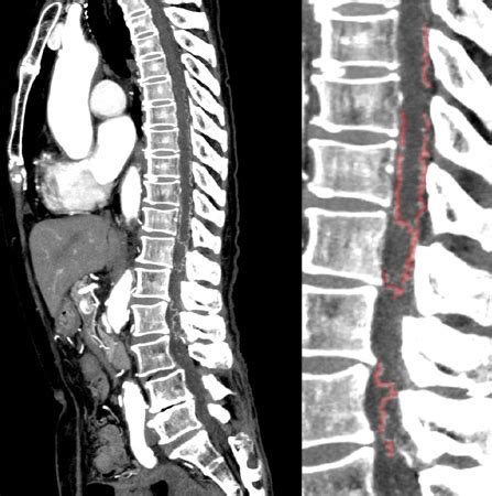 비탄의 망령은 은퇴하고싶다 1권 선탈주. 脊髄脊椎外科 | 島根大学医学部脳神経外科学講座