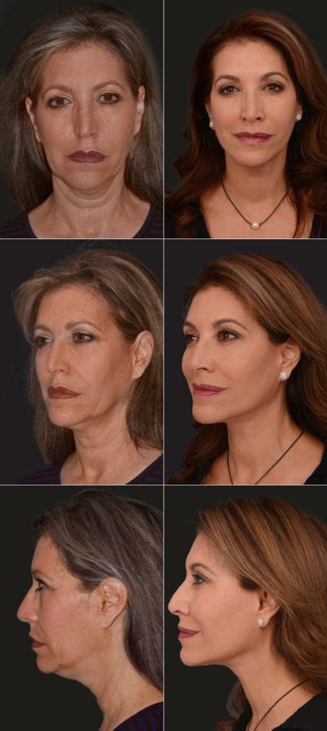 Sculpting The Jawline A Youthful Jawline Makes For A Youthful Face