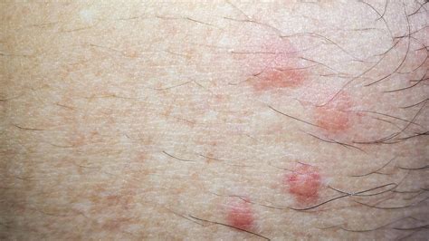 Flea Bites On Humans Pictures Risks Treatment And More