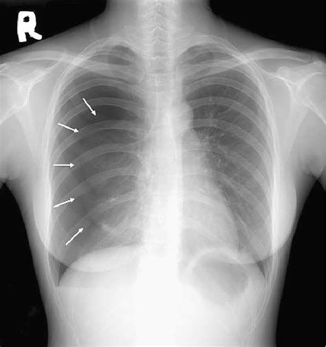 Tension Pneumothorax X Ray Pneumothorax And Its Management