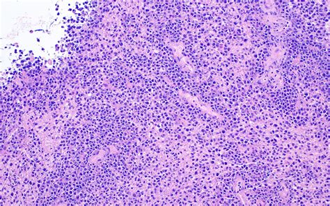 Pathology Outlines Primary Cns Lymphoma