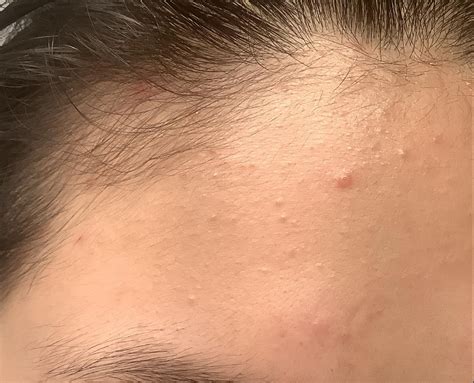 Skin Concerns Its Been Three Months Since I Began Developing Small