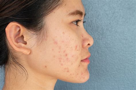 Make Acne Scars A Thing Of The Past Westerville Dermatology