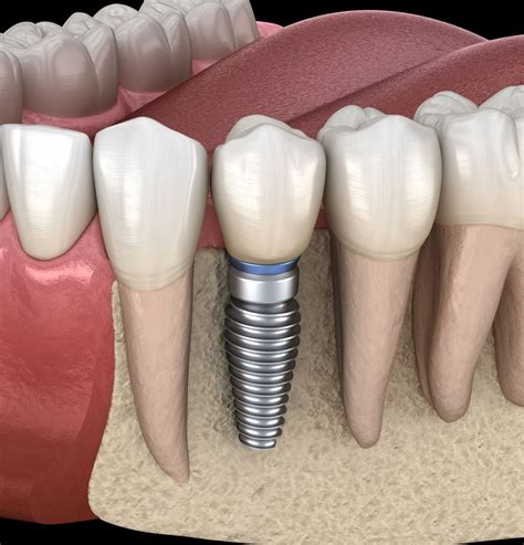 Failing Dental Implants Implant Dentist Albuquerque Nm