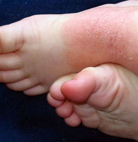 Psoriasis On Feet Symptoms Causes And Treatment