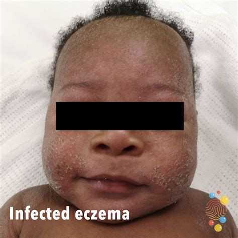 Atopic Eczema On Black Skin