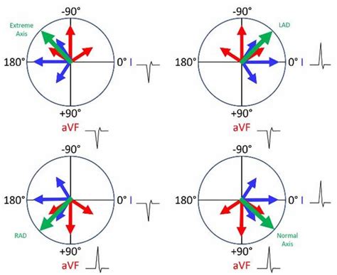 Heart Left Axis Deviation Causes Symptoms And Treatment