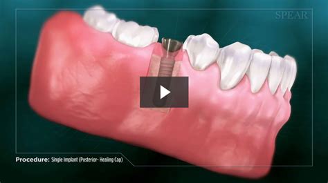 Single Implant Posterior Healing Cap Cosmetic Dentistry
